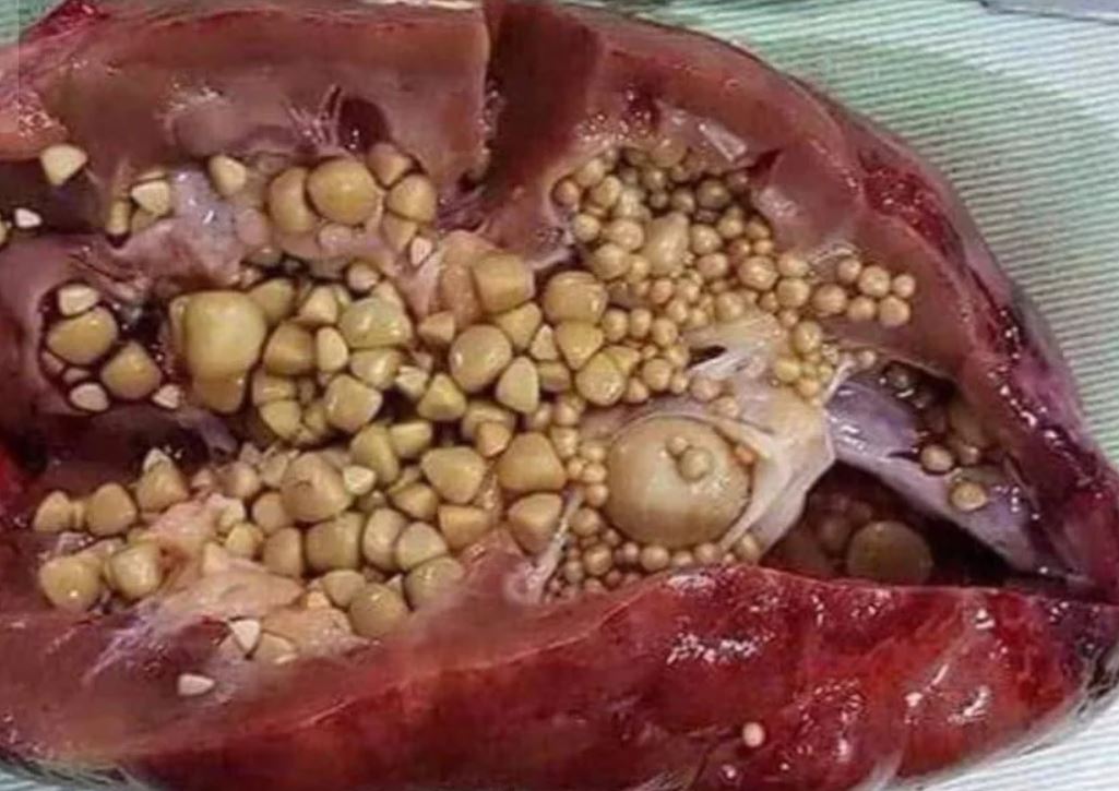 مواد غذایی که از تشکیل سنگ کلیه جلوگیری می‌کند