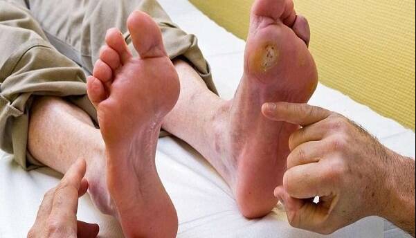 زخم پای دیابتی عارضه‌ای خاموش اما خطرناک