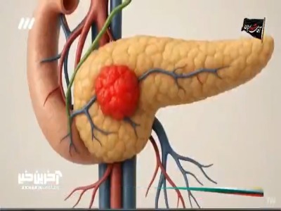 سرطان پانکراس و عوامل ابتلا به آن!